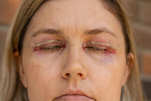 Double Eyelid Surgery, Eyes Surgery Recovery Period, immediately after plastic surgery. Eyes After Eyelid Surgery